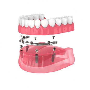 implant retained dentures round